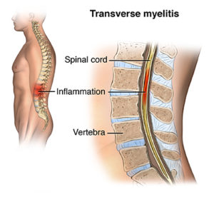 Transverse myelitis